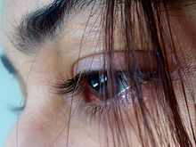 Fibromyalgie - Quelle: Samiksha Kanchankar, CC BY 2.0 (http://www.flickr.com/photos/samiksha/435477163/)
