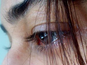 Fibromyalgie - Quelle: Samiksha Kanchankar, CC BY 2.0 (http://www.flickr.com/photos/samiksha/435477163/)